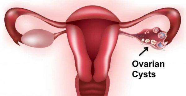 ovarian cyst treatment in Jaipur